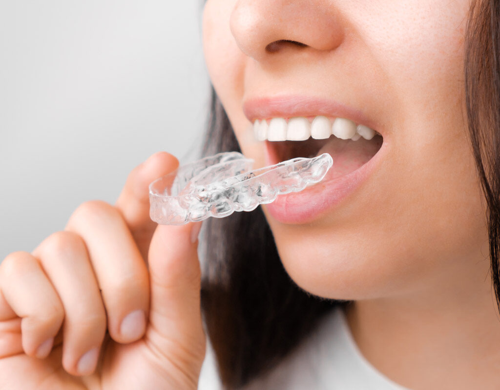 ortodoncia invisible o invisalign